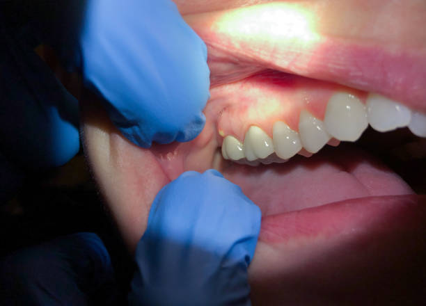 Best Emergency Denture Repair in Pardeeville, WI